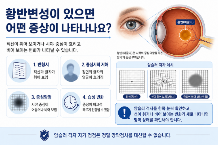 황반변성 증상과 암슬러 격자 변화를 설명하는 의료정보 이미지