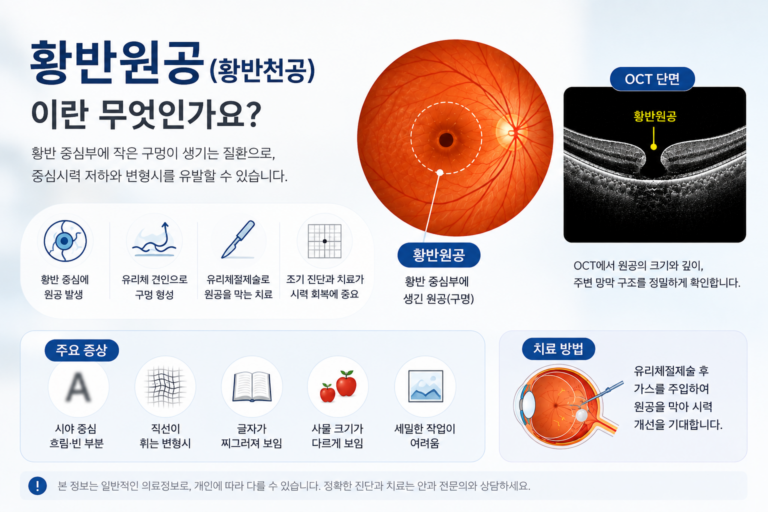 황반 중심부에 원공이 생기는 황반원공의 구조와 OCT 검사를 설명하는 의료정보 이미지