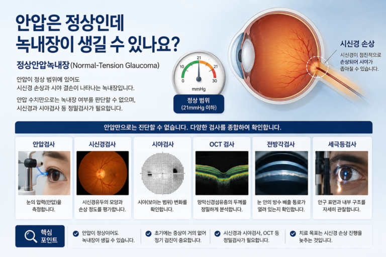 안압이 정상 범위여도 시신경 손상이 나타날 수 있는 정상안압녹내장을 설명하는 의료정보 이미지
