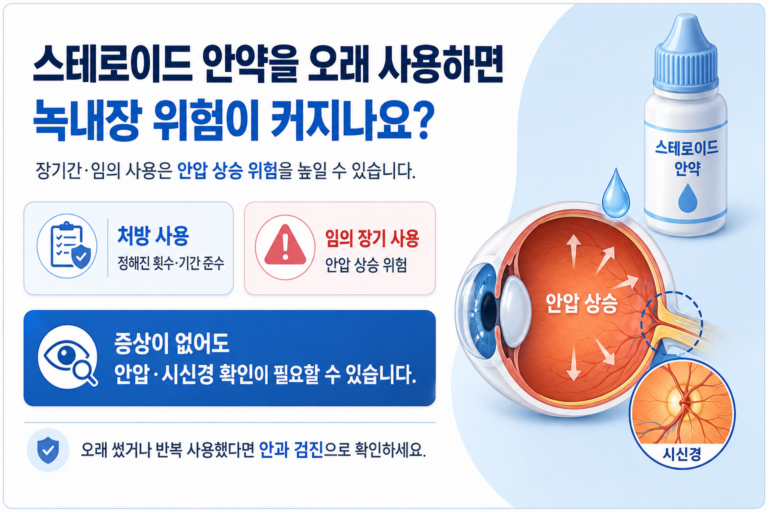 스테로이드 안약 사용과 안압 상승 및 녹내장 위험을 설명하는 의료정보 이미지